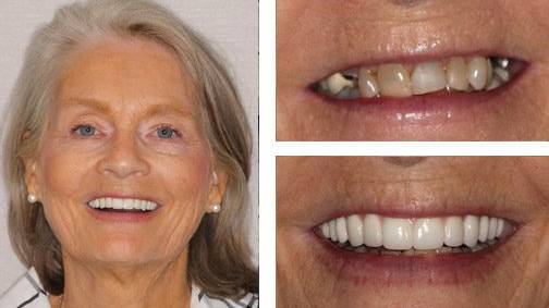 Anita W. — dental implant before and after, Harrell Dental Implant Center Charlotte NC