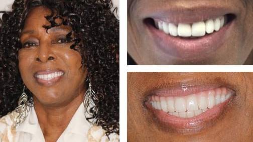 Gloria W. — dental implant before and after, Harrell Dental Implant Center Charlotte NC