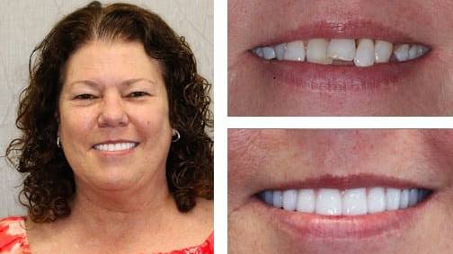 Jane V. — dental implant before and after, Harrell Dental Implant Center Charlotte NC