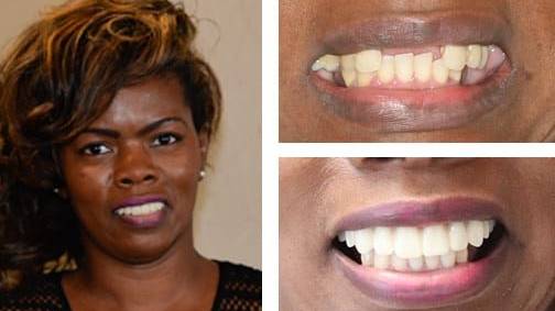 Shelia S. — dental implant before and after, Harrell Dental Implant Center Charlotte NC